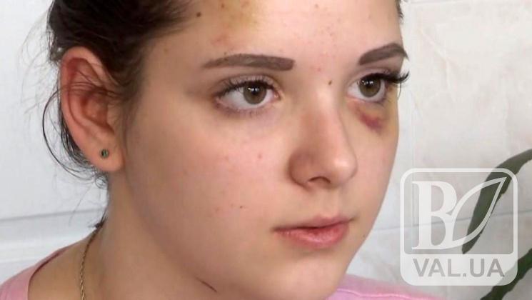 Полине Малоштан, которую жестоко избили девушки-подростки, нужна операция на глазу