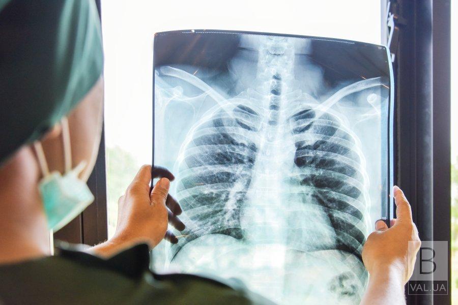 На Чернігівщині за минулий рік захворюваність на туберкульоз зросла на 30%