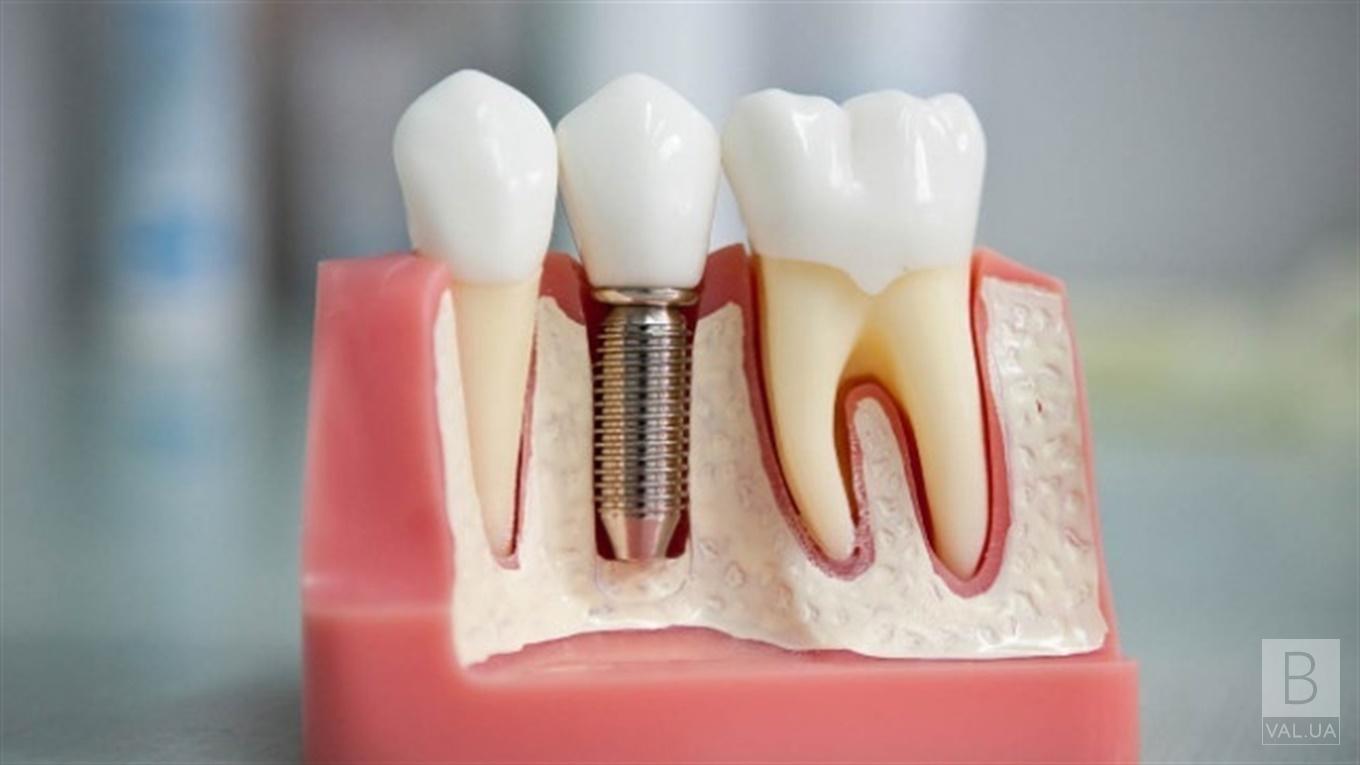 З чого складається вартість зубного імпланту?