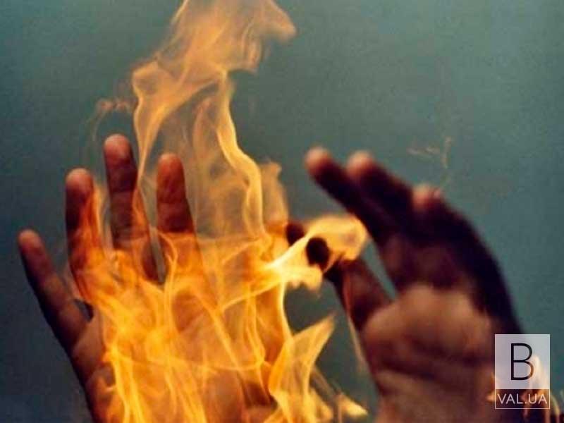На Черниговщине 57-летний мужчина получил ожоги во время пожара