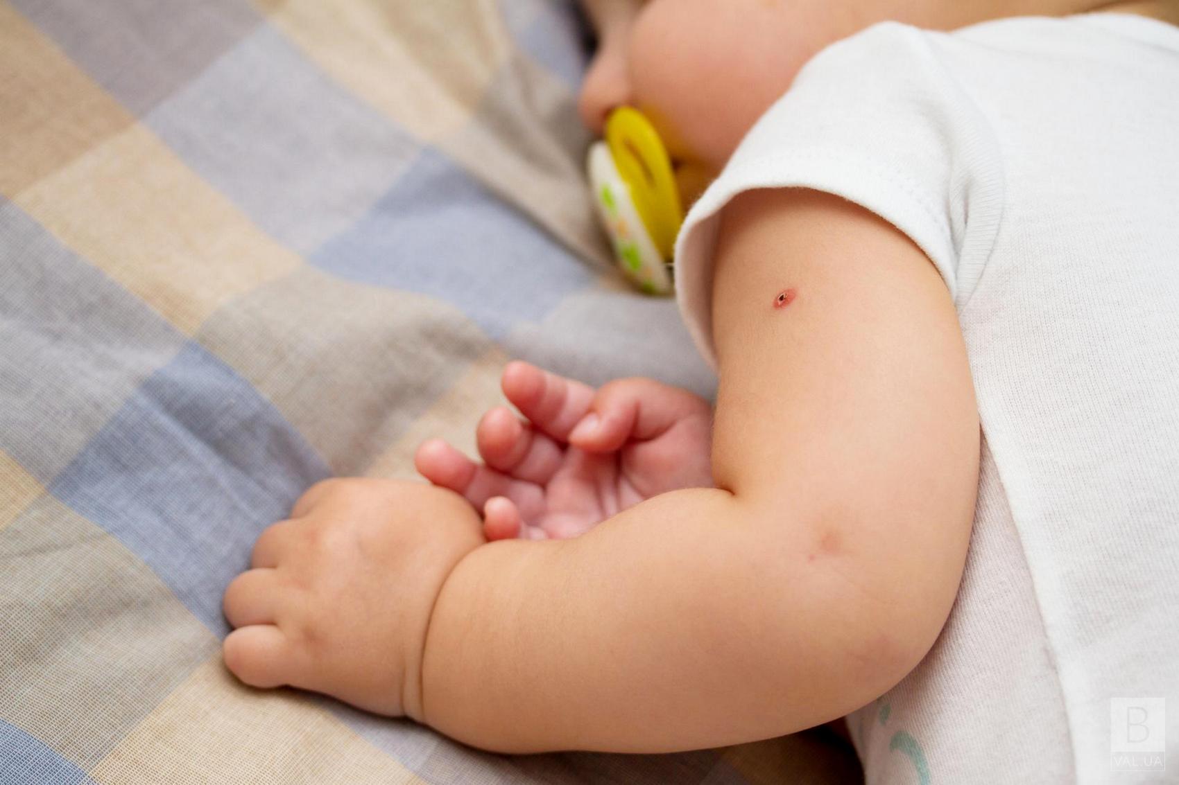 В Україні вже майже місяць немовлят не щеплять від туберкульозу: в пологових будинках закінчилася вакцина БЦЖ
